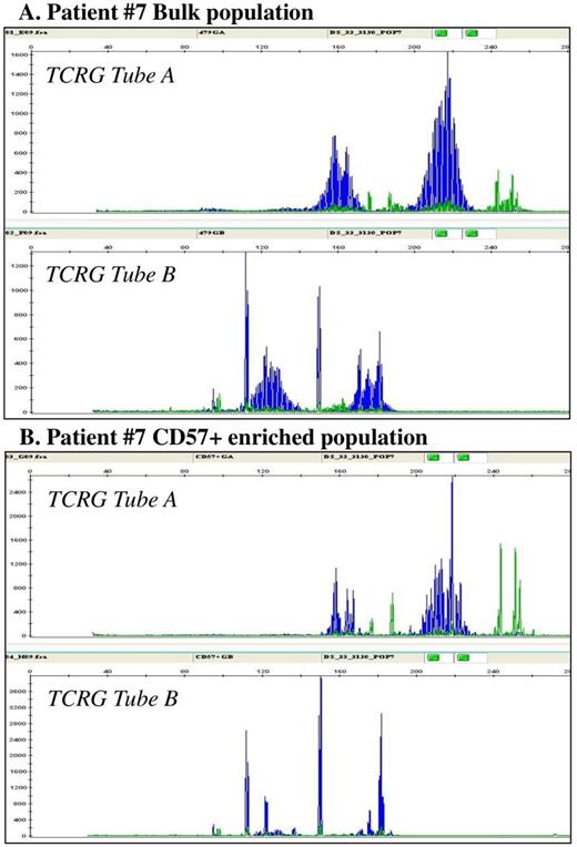 Figure 2. Results of TCRGclonalityassessment for patient #7 with monoclonal pattern in bulk population (A) andoligoclonalpattern in CD57+ enriched lymphocyte population (B).