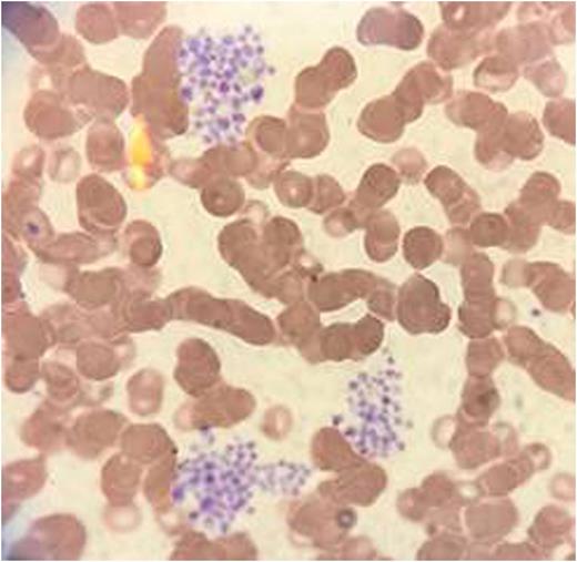 Figure 1. Platelet Clumps- Magnification 60X Oil