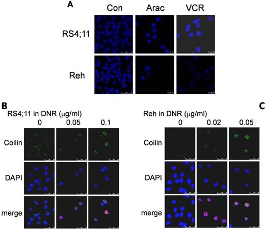Figure 2. Daunorubicin (DNR) induced accumulation of Coilin. (A) Morphology of Cajal bodies in RS4;11 or Reh in native and conditions treated with Ara c or VCR. Dose-dependent coilin accumulation was observed in RS4;11 cells (B) treated with increasing concentrations of DNR (0, 0.05 and 0.1 m g/ml) or in Reh cells (C) treated with DNR of 0, 0.02 and 0.05 mg/ml.