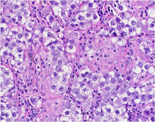 Figure 1. Testicular mass- Seminoma