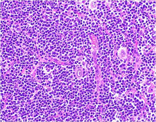 Figure 2. Lymph node biopsy- Classic Hodgkin's lymphoma