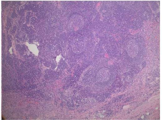 Figure 1. Low power (5X magnification) showing targetoid pattern of follicles and prominent interfollicular stroma with prominent capillaries consistent with Castleman's and a spindle cell proliferation towards the bottom consistent with Kaposi Sarcoma