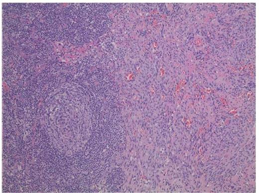 Figure 2. Higher magnification (10X) shows a prominent follicle with concentric layering of peripheral lymphocytes that resembles onion-skin. To the right, the KS shows spindle cells forming slits with extravasated red blood cells.