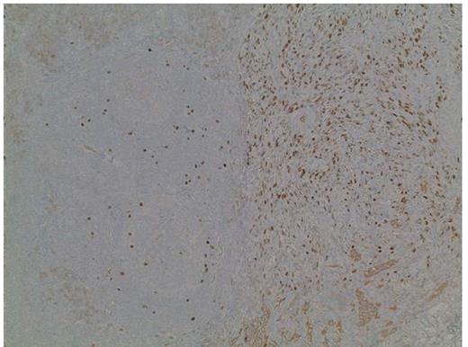 Figure 3. HHV-8 nuclear immunostain highlights KS cells with nuclear staining.