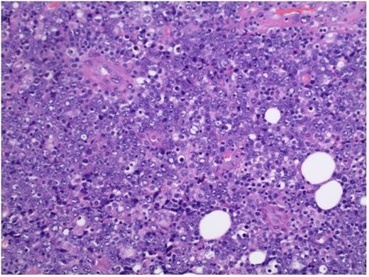 Figure 1. H&E section showing a monomorphic proliferation of malignant cells with large immunoblastic tumor cells with prominent nucleoli. Magnification 20X.