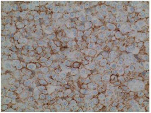 Figure 2. CD138 immunohostochemical stains showing positivity in neoplastic cells.