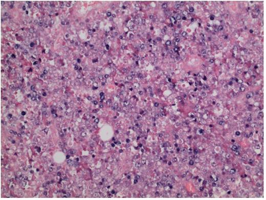 Figure 3. EBV EBER stain by in situ hybridization showing nuclear positivity in neoplastic cells.