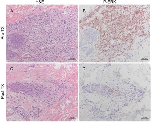 Figure 1. Skin biopsies pre- and post-trametinib. (A)(C) H&E staining shows diminished lymphocyte involvement. (B)(D) PhosphoERK immunostaining shows decrease of phosphoERK expression. Bar = 500 μm