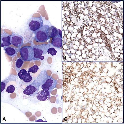 Figure 1. The marrow aspirate from Fig. 1 shows abnormal plasma cells (A). Immunohistochemistry on the concomitant biopsy shows the presence of numerous CD138-positive (B) and CD38-positive (C) plasma cells.