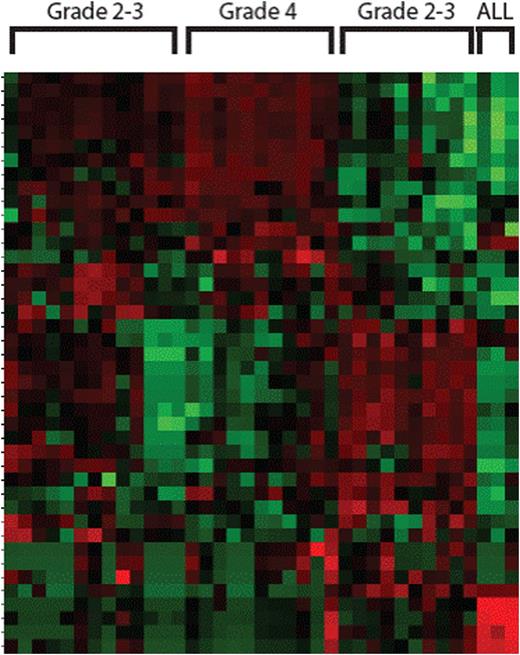 Figure 2. Unsupervised clustering shows four groups of CRS clusters based on T cell, monocyte and B cell genes. Each column is a patient sample, each row a single gene. Grade 4 is dominated by T cell genes only.