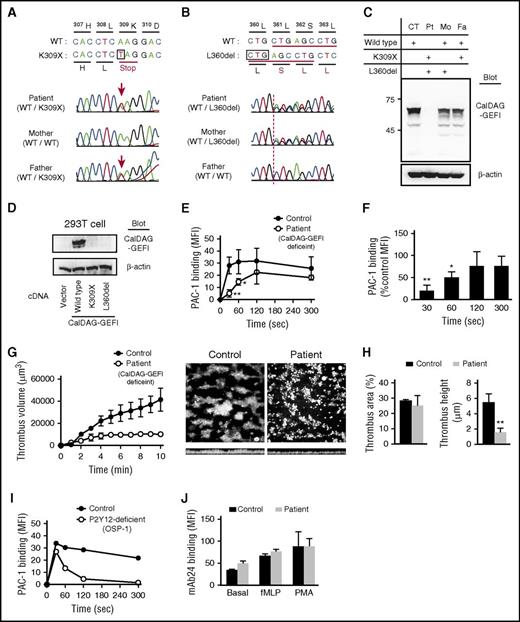 Figure 2. Compound heterozygous CalDAG-GEFI mutation causes CalDAG-GEFI deficiency in patient platelets and delayed integrin αIIbβ3 activation kinetics. (A-B) Sequencing results of CalDAG-GEFI showing the heterozygous 1178A>T mutation (K309X) in patient (top) and father (bottom) (A) and heterozygous 1331_1333 deletion (L360del) in patient (top) and mother (middle) (B). Genomic DNA isolated from peripheral blood mononuclear cells was used as a template for polymerase chain reaction and amplified DNA fragments were sequenced. Reverse transcription polymerase chain reaction analysis of platelet mRNA also confirmed these mutations (data not shown). (C) Western blot analysis of CalDAG-GEFI in platelets from control, patient, her mother, and her father. (D) Western blot for CalDAG-GEFI in 293T cells transfected empty vector, wild-type CalDAG-GEFI, or mutant CalDAG-GEFI (K309X and L360del) vector. (E) Platelet integrin αIIbβ3 activation kinetics determined by initial velocity assay. Washed control and patient platelets were mixed with 100 μM PAR1-AP at time “zero.” At each indicated time point, 20 μL FITC-PAC-1 was added to the mixture. After 30 seconds of incubation with FITC-PAC-1, bound FITC-PAC-1 was immediately assessed by flow cytometry (n = 3: mean ± SD; Student t test, *P < .05, **P < .01). (F) The percentage of FITC-PAC-1 binding to patient platelets relative to control platelets. PAC-1 binding to patient platelets relative to control platelets at each time point was indicated as percent control MFI (n = 3: mean ± SD; Student t test, *P < .05, **P < .01). (G) Shear-induced thrombus formation. Whole blood from control or patient was perfused over collagen-coated surface at a wall shear rate of 1250 seconds−1. Thrombus volumes were measured by MetaMorph and VoxBlast software every minute (n = 3: mean ± SD). Representative thrombus images after 10 minutes of perfusion were shown (top and side view). (H) Statistical analysis of thrombus area and height. Surface coverage by adhered platelets (left) and thrombus height (right) after 10 minutes of perfusion were analyzed (n = 3). (I) Platelet integrin αIIbβ3 activation kinetics in patient with OSP-1 determined by initial velocity assay. In platelets of OSP-1, rapid initial αIIbβ3 activation at 30 seconds was induced the same as control platelets. However, αIIbβ3 activation was transient and almost no αIIbβ3 activation velocity at 300 seconds. (J) β2 integrin activation in neutrophils. Whole blood was stimulated with 200 nM fMLP or 100 ng/mL PMA, and induced β2 integrin activation was determined by binding of monoclonal antibody 24, which recognizes the activated form of β2 integrin (n = 3: mean ± SD; Student t test). WT, wild type.