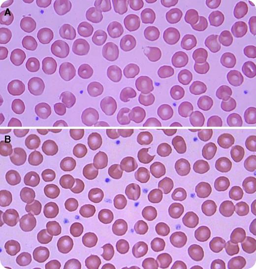 A 21-year-old African American man with HIV infection, well controlled with emtricitabine, rilpivirine, and tenofovir, presented with new onset of jaundice. The night before presenting, he took the sexual enhancement drug called “RUSH.” Initial investigations revealed a hemoglobin of 12.2 g/dL, mean corpuscular volume of 100 fL, reticulocyte count of 0.12 million/mm3, white blood count of 5200/mm3, platelets of 208 000/mm3, indirect bilirubin of 13.8 mg/dL, lactate dehydrogenase of 388 IU/L (normal level <241 IU/L), haptoglobin of <10 mg/dL, and negative direct Coombs test. A peripheral smear revealed bite cells and blister cells (panels A and B; original magnification ×100; Wright-Giemsa stain). The patient was treated supportively, and his hemolysis resolved within a few days. The level of glucose-6-phosphate-dehydrogenase (G6PD) during crisis was found to be severely decreased at 0.7 U/g (reference range, 9.9-16.6 U/g). A diagnosis of hemolytic anemia secondary to RUSH in a patient with G6PD deficiency was made. His hematologic parameters returned to baseline after the hemolytic crisis, but G6PD remained low. / RUSH is commonly used for sexual enhancement, especially in the homosexual population. Its active ingredient is amyl or butyl nitrite, which works primarily as a smooth muscle relaxant. Only a few cases have been reported of hemolytic anemia induced by RUSH. Apart from hemolysis, it can also induce methemoglobinemia, which can be fatal if not treated promptly.