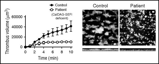 Human platelets lacking CalDAG GEFI do not form “clots” on immobilized collagen. Blood from a healthy human control or from a patient lacking CalDAG GEFI was perfused over immobilized collagen at a high shear rate intended to mimic arterial blood flow. Control platelets (left image) adhere directly to the collagen surface via multiple receptors and coalesce normally into islands of three-dimensional clotlike structures as a result of primary and secondary signaling pathways that converge upon the αIIbβ3 integrin. In contrast, the patient’s platelets (right image) adhere normally but do not form three-dimensional structures because of a lack of αIIbβ3 activation caused by the absence of CalDAG GEFI. Cross-sectional images of these adherent platelets (bottom images) demonstrate fewer platelets and smaller aggregates in the patient. Platelet numbers are clearly reduced in the patient’s clots as depicted by the plot of total fluorescence intensity (volume) on the left. See Figure 2G in the article by Kato et al that begins on page 2729.