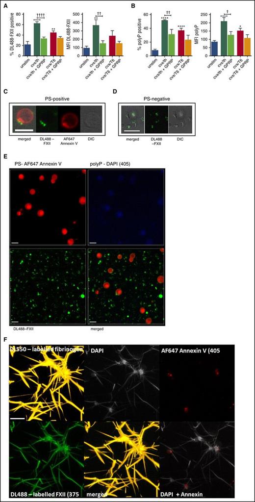 Figure 6. FXII and polyP bind to the surface of stimulated platelets. (A-B) Washed human platelets were incubated with DL488-labeled FXII and DAPI to detect platelet-derived polyP and were left unstimulated (unstim) or stimulated with 100 ng/mL of CVX and 100 nM thrombin (cvx/th) or with 100 ng/mL of CVX and 20 μM TRAP-6 (cvx/T6), with or without 5 mM GPRP, for 45 minutes at ambient temperature before analyzing DL488-FXII-positive cells (A) and DAPI-positive cells (B) by flow cytometry. **P < .01, ****P < .0001 vs unstim platelets; †P < .05, ††P < .01, ††††P < .0001 cvx/th-stimulated platelets vs cvx/th + GPRP. (C-E) Washed platelets (5 × 107/mL) were activated with 20 μg/mL of collagen and 100 nM thrombin in the presence of DL488-FXII (green) and DAPI (blue; seen in panel E) and stained using AF647-annexin V to detect PS (red). Images represent 3-dimensional render of z-stacks. Scale bars represent 5 μm. Representative images of 3 separate experiments. (F) Platelets (1.5 × 108/mL final concentration) were activated with 100 μg/mL of collagen and 100 μM TRAP-6 in the presence of CaCl2 before adding to plasma clots (50%) in the presence of DyLight 550 (DL550)-labeled fibrinogen (120 nM; orange), DL488-FXII (365 nM; green), DAPI (20 μg/mL; light gray), and AF647-annexin V (1/20; red). Thrombin (24 nM) and CaCl2 (10 mM) were added, and clots were allowed to form for 2 hours. The image is representative of 3 separate experiments and displays a 3-dimensional render of a z-stack. Scale bar represents 10 μm. Images in C-F were obtained using a Zeiss LSM710 confocal microscope with a ×63/1.40 oil immersion objective and were analyzed using Zen 2012 software. DIC, differential interference contrast; MFI, median fluorescence intensity.