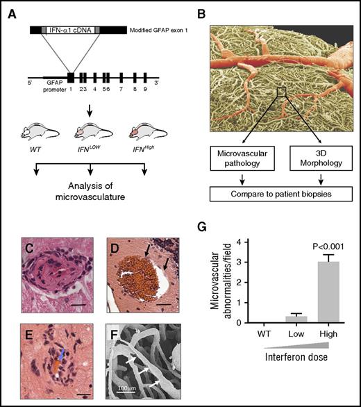 Figure 4. Type I IFN causes a dose-dependent microangiopathy. (A) Overview of experimental design (see text), with structure of the fusion gene used to generate the GFAP-IFN-α transgenic mice. (B) Scanning electron micrograph of IFNHigh vascular cast, colored to show larger vessels (red) and microvasculature (box, yellow). (C-E) Hematoxylin and eosin sections of mice with maximal IFN overexpression show a spectrum of dose-dependent microangiopathic pathology, including endothelial hypertrophy and intimal thickening (C), microaneurysms (black arrows, D), and perivascular inflammatory cell infiltration and red bloods cells within narrowed lumen (blue arrows, E). Bars represent 20 μm. (F) Scanning electron micrograph of small vessel cast showing variation in microvessel caliber (white arrows). (G) Microvascular pathology in IFN-overexpressing mice is dose dependent. WT, wild type, no transgenic overexpression; IFNLow, transgenic line with low IFN overexpression; IFNHigh, transgenic line with high IFN overexpression (n = 8 mice per group). Data represent mean ± SEM; 1-way ANOVA, P < .001.