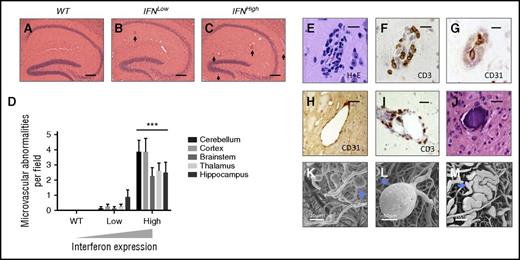 Figure 6. Spectrum of microvascular abnormalities observed in a focal model of type I IFN toxicity. A spectrum of microvascular disease is observed in mice with transgenic production type I IFN in the brain, across all anatomical regions. (A-C) Dose-dependent microvascular pathology in the hippocampus of transgenic mice with zero, low, and high levels of IFN overexpression (hematoxylin/eosin, abnormal small blood vessel highlighted by black arrow). (D) Dose-dependent microvascular pathology was observed across all major brain regions. ***P < .01, 1-way ANOVA for each region; n = 8 each group. (E-G) Perivascular inflammatory cell infiltration: hematoxylin/eosin (H+E), CD3, and CD31 immunohistochemistry shows small blood vessels with T-cell infiltration (CD3) and narrowing of lumen (CD31 endothelial marker). (H) Ectatic small vessel. (I) Perivascular infiltration by T cells (CD3, brown). (J) Intravascular calcification; bars represent 20 μm (E-G) and 40 μm (H, I). Scanning electron microscopy of microvascular cast shows multiple small capillary microaneurysms (K, blue arrow), large microaneurysm (L), and ectatic microvessel (M, blue arrow).