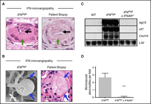 Figure 7. Specific pathological features of IFN-associated microangiopathy are seen in patient renal biopsy material and are mediated through the type I IFN receptor. (A-B) Microvascular pathology identified in this model includes specific pathological abnormalities such as luminal narrowing (black arrows), endothelial hyperplasia (green arrows), and microaneurysm formation (blue arrows), which were seen in the biopsies of the patients described previously. Bars represent 20 μm. (C) Upregulation of IRGs (Isg15, Irf7, Cxcl10) was observed in IFNHigh transgenic mice and absent in mice that lack the type I IFN receptor (IFNHigh × IFNAR−/−). Total RNA was extracted from the brain of WT and transgenic mice and analyzed by ribonuclease protection assay and visualized by autoradiography (n = 3 per group). (D) Rescue of microvascular pathology in IFNHigh mice that lack the type I IFN receptor (IFNHigh × IFNAR−/−). Data represent mean ± SEM; ***P < .001, Student t test compared with IFNHigh; n = 8 regions.