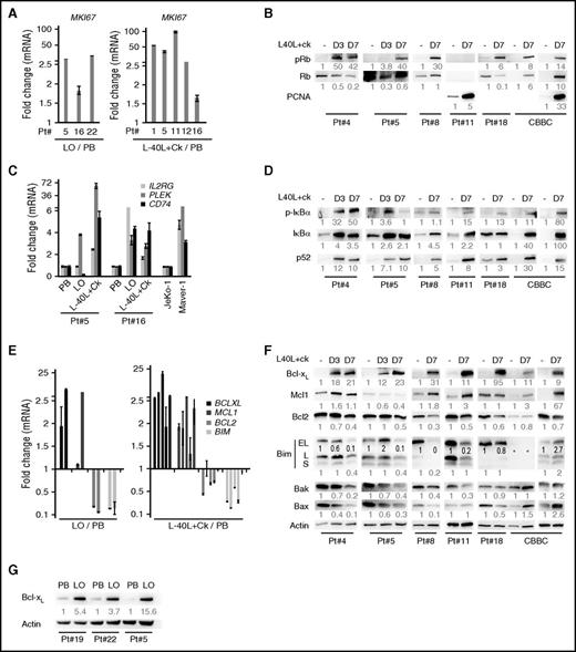 Figure 2. Extrinsic stimulations result in proliferation, NF-κB activation and in an unbalanced modulation of the Bcl-2 family in primary MCL cells. (A) qRT-PCR analysis of MKI67 from: left, primary MCL cells concomitantly isolated from LO (Pts 5 and 22: lymph node, Pt16: spleen) and PB; right, PB primary MCL cells cocultured on an L-40L layer in the presence of cytokines (D7) and relative to PB. (B) Immunoblotting of cell-cycle related proteins (pRb, Rb, PCNA) in primary CD5+ cells isolated from healthy donor (CBBC) or MCL patients (PB) at D0 and after coculture on L-40L+Ck at the time indicated (D3, D7). (C) qRT-PCR analysis of NF-κB target genes (IL2RG, PLEK, and CD74)35 in primary MCL cells cultured as in panel A. Maver-1 and JeKo-1 were used as NF-κB signaling positive and negative controls, respectively.4 (D) Immunoblotting of classical (p-IκBα) and alternative (p52) NF-κB pathway proteins in primary MCL cells as in panel B. (E) qRT-PCR analysis of indicated genes in primary MCL cells cultured as in panel A. (F) Immunoblotting of Bcl-2 family proteins in primary MCL cells as in panel B. *Highlights Bim underexposure resulting from high expression in sample 18. (G) Immunoblotting analysis of indicated proteins in primary MCL cells concomitantly isolated from LO and PB. Quantification of protein level was normalized to actin and indicated below each protein.