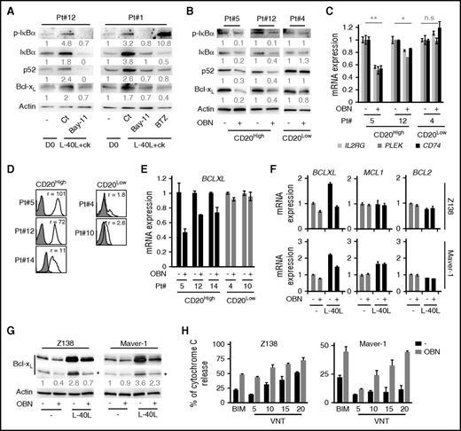 Figure 5. Obinutuzumab counteracts microenvironment-dependent loss of priming through NF-κB inhibition and Bcl-xL downregulation in primary MCL cells. (A) Immunoblotting of indicated proteins in primary MCL cells cocultured on L-40L for 6 hours in the presence or absence of the NF-κB inhibitor Bay11-7082 (Bay11: 5 µM) or proteasome inhibitor BTZ (50 nM). (B) Immunoblotting analysis of the indicated proteins in CD20High or CD20Low primary MCL cells in the presence or absence of OBN (48 hours; 5 µg/mL). (C) qRT-PCR analysis of NF-κB targets (IL2RG, PLEK, and CD74)35 in CD20High or CD20Low primary cells. (D) CD20 expression levels measured by fluorescence-activated cell sorting analysis on CD19+CD5+ primary MCL cells. (E) qRT-PCR analysis of BCLXL gene in CD20High (black bars) or CD20Low (gray bars). L-40L+Ck cocultured primary MCL cells in the presence or absence of OBN (24 hours; 5 µg/mL). (F-G) qRT-PCR analysis of BCLXL, BCL-2, and MCL-1 (F) and immunoblotting of Bcl-xL (G) in Z138 and Maver-1 cells cocultured or not on L-40L cells in the presence or absence of OBN (24 hours; 5 µg/mL). (H) BH3-profiling of Z138 and Maver-1 cells cocultured on L-40L+Ck in the presence or absence of OBN (24 hours; 0.5 µg/mL), was performed as described in “Methods.”