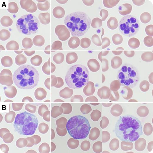 A 39-year-old man with a history of intravenous drug abuse and hepatitis C virus infection was found unresponsive on the street in Tucson, Arizona. His temperature was 41.8°C and he was tachycardic, hypotensive, and hypoxemic. A complete blood count showed white blood cell count of 17.8 × 109/L, red blood cell count of 5.21 × 1012/L, hemoglobin level of 164 g/L, mean corpuscular volume of 97.6 fL, red cell distribution width of 13.8%, and platelet count of 386 × 109/L. A urine drug screen detected opiates and amphetamines. The peripheral blood showed absolute neutrophilia with a shift to immaturity and botryoid-type hypersegmentation of the neutrophils (65% affected; panel A, original magnification ×100; Wright-Giemsa stain), monocytes (panel B, original magnification ×100; Wright-Giemsa stain), and lymphocytes. These morphologic features returned to normal 24 hours after hydration and cooling. / Although neutrophil hypersegmentation can be seen in vitamin B12 and folate deficiencies, heat shock, or amphetamine overdose, the morphologic features differ depending on the underlying cause. In nutritional deficiencies, the number of segments is increased up to 5, 6, and rarely 7. Conversely, in heat shock and amphetamine overdose, the neutrophils, monocytes, and lymphocytes are hypersegmented up to 9 lobes emanating from a single centriole with radial segmentation: the so-called botryoid type. Leukocyte morphology and mean corpuscular volume can help differentiate the diagnosis.