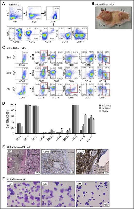 Figure 2. Mouse xenograft AML model using sample AML #2. (A) Fluorescence-activated cell sorting (FACS) immunophenotype of AML #2 patient-derived MNCs. (B) Representative photograph depicting the leukemic masses formed around the extramedullary bones of scaffold 1 (Sc1) and Sc3 and 2 scaffolds with no tumor growth (Sc4, not injected control scaffold), at mouse euthanasia. (C) Representative FACS phenotype from a primary huBM-sc mouse (m23; supplemental Table 1) transplanted with AML #2 cells. Expression of a panel of hematopoietic markers in huCD45+ gated cells isolated from different scaffolds or from the murine BM. (D) Bar graph summarizing the FACS phenotype of human CD45+ cells from different compartments of all mice injected with #2 AML cells compared with the original patient phenotype. Values are expressed as mean ± SEM. (E) Histologic sections of scaffold tumor from a representative #2 huBM-sc mouse (m24, Sc1) stained with H&E, anti-huCD45, or anti-huCD33 antibodies. (F) Representative images (m23) of May-Grünwald-Giemsa–stained cytospins of cells retrieved from Sc1, Sc3, or BM. DAPI, 4′,6-diamidino-2-phenylindole; FSC, forward scatter; pt, patient; SSC, side scatter.