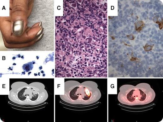 A 43-year-old woman with tobacco use and asthma was admitted to the hospital for dyspnea, productive cough, and fever. A computed tomography (CT) scan of her chest showed a large cavitary mass concerning for lung abscess or malignancy. On physical examination, the patient was found to have digital clubbing of her hands (panel A) and a single enlarged left supraclavicular lymph node. Sputum cytology revealed a Reed-Sternberg cell (panel B; original magnification ×60, Pap stain). Diagnosis of Hodgkin lymphoma was confirmed on biopsy of the enlarged supraclavicular lymph node with morphology (panel C; original magnification ×60, hematoxylin and eosin stain) and CD30 staining (panel D; original magnification ×60, mouse antihuman CD30 monoclonal antibody stain). A subsequent positron emission tomography (PET)/CT scan showed the cavitary lung lesion (panel E) to be intensely fludeoxyglucose avid (panel F). Based on the above, the patient was diagnosed with Hodgkin lymphoma presenting with a cavitary lung mass. Following 2 cycles of doxorubicin (Adriamycin)-bleomycin-vinblastine-dacarbazine (ABVD) chemotherapy, the patient had a repeat PET/CT scan showing resolution of her disease (panel G). She went on to receive a total of 6 cycles of ABVD for advanced-stage Hodgkin lymphoma. / Pulmonary parenchymal involvement by Hodgkin lymphoma is a rare entity confined to case reports. The clinical and radiographic presentation can be nonspecific and mimic other malignant or infectious causes. Interestingly, this patient's sputum sample provided the first indication of Hodgkin lymphoma and was later confirmed by lymph node biopsy and further imaging.