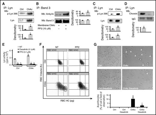 Figure 1. Chorea-acanthocytosis (ChAc) red cells show weakening of band-3 ankyrin interactions and increased cytosolic active Lyn. (A) (Upper) Total Lyn was immunoprecipitated from detergent-solubilized red cells membranes of healthy (Ctrl, control) and ChAc subjects and detected with antibody to active Lyn (phospho-Lyn 396) or total Lyn (Wb, western blot). The representative experiment shown is 1 of 16 similar experiments, each with red cells from an individual ChAc subject and each with similar results. A colloidal Coomassie-stained twin gel is shown in supplemental Figure 1. (Lower) Densitometric analysis of the immunoblots; data are shown as means ± standard deviation (SD: n = 16; *P < .05 compared with healthy red cells). (B) Band 3 was immunoprecipitated (IP) from detergent-solubilized membranes of ChAc red cells previously incubated without or with the inhibitor PP2 (10 μM). The IPs were subjected to western blot (Wb) analysis with anti-ankyrin antibody and with anti–band 3 antibody. The figure is representative of 3 independent experiments with similar results. Densitometric analysis of the immunoblot bands is shown at right. Data are shown as means ± SD (n = 6; *P < .05 compared with control untreated ChAc red cells). (C) (Upper) Total Lyn was immunoprecipitated from red cell cytosol fraction of healthy (Ctrl, control) and ChAc subjects and detected with antibody to active Lyn (phospho-Lyn 396) or antibody to total Lyn. The experiment shown is representative of 15 such experiments, each from an individual ChAc subject and each with similar results. Colloidal Coomassie-stained twin gel is shown in supplemental Figure 1D. (Lower) Densitometric analysis of the immunoblots; data are shown as means ± SD (n = 15; P < .05 compared with control erythrocytes). (D) (Upper) Total Lyn was immunoprecipitated from red cell cytosol fraction of healthy (Ctrl, control) and ChAc individuals and subjected to immunoblot detection of chorein. The experiment shown is representative of 3 such experiments, each from an individual ChAc subject and each with similar results. (Lower) Densitometric analysis of the immunoblots; data are shown as means ± SD (n = 3; *P < .05 compared with control erythrocytes). (E) Lyn kinase activity from cytosols of control or ChAc red cells was detected using Src-specific CDC2 peptide substrate (6-20) in the absence or presence of Src family-specific inhibitors dasatinib and PP2 (n = 6; *P < .05 compared with untreated red cells). (F) Red cell distribution histograms generated for red cells volume and cell hemoglobin concentration (RBC-HC) of red cells from healthy control (Ctrl) and patients with ChAc without and with PP2 treatment to inhibit Lyn activity. One experiment representative of 7 with similar results is shown. Related values for CHCM and HDW are shown in supplemental Figure 1E. (G) (Upper) Morphology of red cells from healthy and ChAc subjects with and without dasatinib (0.1 μM as in Figure 1D). Cells were imaged at 100× original magnification using a Panfluor objective with 1.30 numeric aperture on a Nikon Eclipse DS-5M camera and processed with Digital Slide (DS-L1) Nikon. One experiment representative of 7 with similar results is shown. (Lower) Quantitation of acanthocytes by brightfield microscopic analysis on ChAc red cells treated with or without dasatinib (0.1 μM). Data from 50 visual fields were collected by 2 blinded researchers. Results are presented as means ± SD (n = 6; °P < .002 compared with healthy red cells; *P < .05 compared with vehicle-treated ChAc red cells).