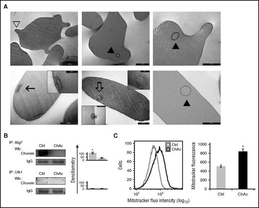 Figure 5. ChAc red cells show accumulation of multivesicular bodies and delayed mitochondrial clearance. (A) ChAc red cells of normal shape and spiculated acanthocytes (open arrowhead) are both found in peripheral blood of ChAc patients (upper left; bar, 2 μm). Ring-shaped membrane structures (solid arrowhead) are found in both acanthocytes (upper center and right panel; bar, 1 and 0.5 μm, respectively) and in ChAc red cells of normal shape (lower right panel; bar, 0.5 μm); remnants of individual and paired double membrane (lower left panel, higher original magnification in inset; bar, 0.5 and 0.2 μm, respectively) are also visible. In ChAc red cell, multivesicular bodies are found close to the cell membrane (lower center panel; higher original magnification in upper inset; bar, 0.5 and 0.2 μm, respectively) and may be in the process of being extruded from the cell (lower center panel, lower inset; bar, 0.5 μm). (B) Ulk1 and Atg7 were individually immunoprecipitated from red cell cytosol of healthy (Ctrl, control) and ChAc subjects and then subjected to immunoblot with anti-chorein antibody. The experimental results shown are representative of 6 similar experiments, each from an individual ChAc subject. IgG was used as loading control. Data are shown as means ± SD (n = 6; *P < .01 compared with ChAc subjects). (C) (Left) Flow cytometry of reticulocyte-enriched red cell fractions from healthy (Crtl, control) and ChAc subjects intravitally stained with MitoTrack. One representative of 3 independent experiments with similar results. (Right) Data are shown as means ± SD (n = 3; *P < .05 compared with healthy fractioned red cells).