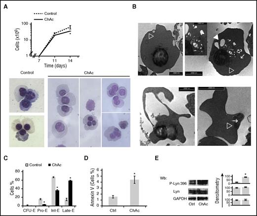 Figure 6. ChAc diserythropoiesis, remnant intracellular vesicles, and accumulation of active Lyn during erythroid maturation. (A) (Upper) Cell proliferation of erythroid precursors derived by in vitro liquid culture of CD34+ cells isolated from peripheral blood of normal (control cells) subjects and ChAc subjects (n = 6). Data are presented as means ± SD; *P < .05 compared with control cells. Percentage decrease in cell number was 53.2 ± 2.9% (n = 6). (Lower) Morphology of culture day 14 erythroid precursors from healthy controls and ChAc subjects. Cytospins were stained with May-Grunwald-Giemsa. Cells were imaged under oil at 100× original magnification using a Panfluor objective with 1.30 numeric aperture on a Nikon Eclipse DS-5M camera and processed with Digital Slide (DS-L1) Nikon. Images representative of 6 separate experiment at 14 days of culture. Quantification of bi-trinucleated cells is reported in supplemental Figure 5C. (B) Electron microscopy of ChAc erythroid precursors at 14 days of culture. (Upper) Hemoglobinized cells of roundish shape filled exhibit pyknotic nucleus and cytoplasmic organellar remnants, including mitochondria (open arrowhead), profiles of endoplasmic reticulum (arrow), and small (open arrow) and large (solid arrowhead) vesicles. Scale bar, 2 μm. Remnants at higher original magnification are shown in the inset; bar, 1 μm. (Lower left) Small erythroid cell, a portion of cytoplasm is apparently detaching from the cell body: bar, 2 μm. (Lower right) A mature, acanthocytoid erythrocyte shows organelle remnants in the cytoplasm (mitochondrion, open arrowhead, endoplasmic reticulum, arrow); bar, 2 μm. (C) Cytofluorimetric maturation analysis of day 14 erythroid precursors (see also supplemental Materials and methods for gating strategy). This cyto-fluorimetric strategy allows the identification of the following homogenous cell populations: pro-erythroblasts (Pro-E), basophilic erythroblasts corresponding to intermediate erythroblasts (Int-E), and polychromatic and orthochromatic erythroblasts as late erythroblasts (Late-E). Data are expressed as percentages shown as means ± SD (n = 4). (D) Amount of annexin-V–positive cells at 14 days of culture in healthy controls and ChAc subjects. Data are expressed as means ± SD (*P < .05 compared with healthy controls, n = 4). (E) Immunoblot analysis of phospho-Lyn and total Lyn in erythroblasts from healthy (control, Ctrl) subjects and ChAc subjects at 14 days of culture. GADPH was used as loading control. One representative blot from 6 with similar results is presented. Densitometric analysis is presented on the right; data are shown as means ± SD (n = 6; *P < .01 compared with healthy controls).