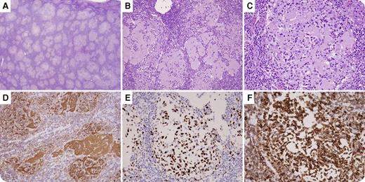 A 57-year-old man with no prior medical history underwent skin excision and sentinel lymph node biopsy for invasive melanoma. The lymph node was grossly enlarged, raising suspicion for metastasis. Histologic evaluation showed a proliferation of atypical follicles that were widely and randomly scattered throughout the lymph node parenchyma (panel A). The follicles were composed of a mixture of centrocytes and relatively fewer centroblasts. The follicles were highly unusual in that abundant extracellular eosinophilic material with morphologic features similar to amyloid was associated with the lymphoma cells (panels B-C). Immunohistochemical studies showed the lymphoma cells were positive for CD20 (panel D), BCL-6 (panel E), BCL-2 (panel F), and CD23 and negative for CD3 and immunoglobulin κ and λ light chains (not shown). Of note, the abundant extracellular material was also positive for CD20 (panel D) and immunoglobulin. A Congo red stain was negative for amyloid deposition. Fluorescence in situ hybridization was negative for IGH-BCL2. These results supported the diagnosis of follicular lymphoma. There was no evidence of metastatic melanoma. / This case demonstrates a highly unusual variant of a common B-cell lymphoma and also emphasizes the importance of communication between pathologists and clinicians as this patient may have been treated for metastatic melanoma if biopsy had not been performed.
