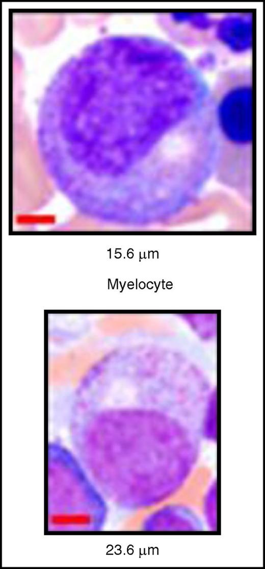 Normal vs increased cell diameter in a dysplastic myelocyte. (Top) Normal myelocyte. (Bottom) Enlarged dysplastic myelocyte with mild hypogranulation. See Figure 3G-H in the article by Basiorka et al that begins on page 2960.