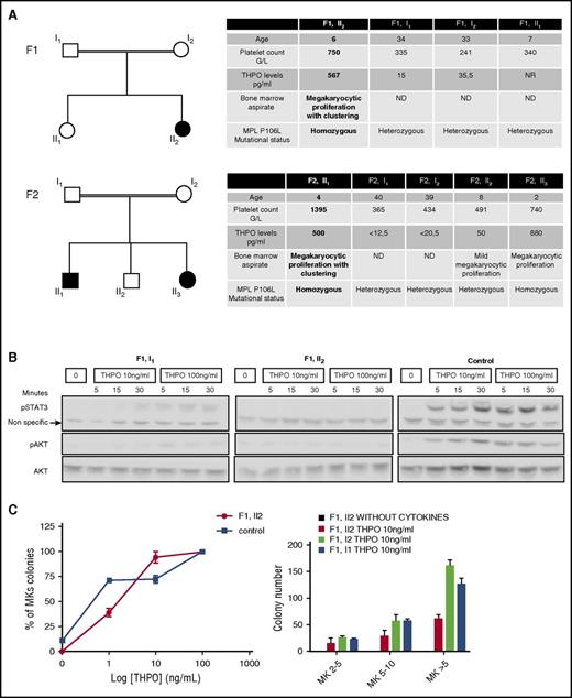 Figure 1. Patient thrombocytosis paradoxically associated with a loss of function receptor. (A) Family trees and biological characteristics: in 2 families, probands are homozygous for the MPL P106L mutation and exhibit thrombocytosis with high levels of THPO and bone marrow megakaryocytic proliferation. (B) Platelet signaling study: STAT3 and AKT activation over a time course were examined by western blot after starvation and subsequent stimulation with THPO at 10 ng/mL or 100 ng/mL and compared with a healthy control. (C) Megakaryocytic proliferation: the MK progenitor compartment response to THPO was studied by plasma clot culture in relative percentage compared with the control or in absolute values. MK colonies were split in 2-5, 5-10, and >10 MKs per colony. The error bars represent mean ± standard deviation of triplicates from a representative experiment.