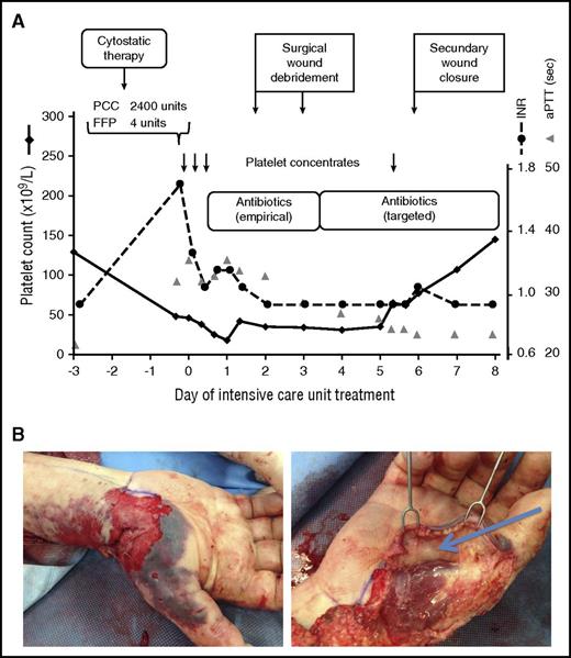 Figure 1. Thrombocytopenia in a septic ICU patient. Although recent cytostatic therapy could have been the reason of the low platelet count at ICU admission (48 × 109/L), sepsis from an infected lower arm wound was responsible for the low platelet count. Causative therapy of sepsis, and thereby of thrombocytopenia, consisted of antibiotic therapy and surgical source control. Transfusion of fresh frozen plasma (FFP), prothrombin complex (PCC), and 4 therapeutic platelet concentrates (each containing 2-4 × 1011 platelets per unit) were given to allow the surgical treatment. (Four-factor PCCs are used in some European centers to improve hemostasis, especially if the patient does not tolerate transfusion of large fluid volumes. This differs from current medical practice in North America.) After the source of sepsis could have been controlled, the platelet count returned to normal without any further measures (A). INR, international normalized ratio; sec, seconds. (B) Operative site during debridement of the infected right forearm injury at an earlier (top) and a later (bottom) time point of surgery.