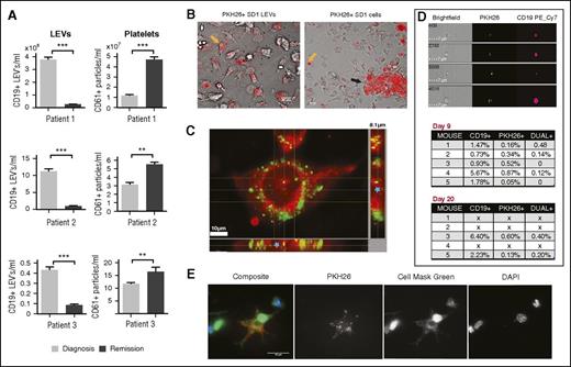 Figure 1. LEVs are produced in vivo and internalized by stromal cells. (A) Diagnostic bone marrow plasma is enriched with CD19+ LEVs. Imaging flow cytometry identified CD19 PE_Cy7 (LEV) and CD61 FITC (platelets)-positive vesicles in matched diagnostic and remission (day 28 postchemotherapy) ALL patient bone marrow plasma samples (1 × 106 events acquired). The number of CD19+ vesicles/mL (LEVs, left) were significantly higher at diagnosis and number of CD61+ extracellular vesicles (platelets, right) significantly higher in remission marrow plasma (**P > .05; ***P > .005). (B) SD1 cells produce LEVs within the bone marrow microenvironment that are internalized by mouse BMSCs. LEVs from 1 × 107 SD1 cells or 1 × 106 SD1 cells labeled with the fluorescent membrane label PKH26 were introduced into the left femur of 5 NSG mice. Bone marrow flushes taken 17 days posttransplantation were seeded onto fibronectin-coated glass coverslips and BMSCs were allowed to adhere overnight. Live cell images were taken using bright field and ultraviolet illumination with Red Sedat filter at ×40 magnification. Scale bar is 20 µm. The left image represents an overlay of the images and shows murine BMSCs with internalized PKH26+ LEVs as indicated by intracellular red fluorescence (yellow arrow). The figure shows variable, punctate perinuclear red fluorescence within the outer membrane of murine BMSCs and not around the periphery of the recipient cell. The right image shows a cluster of PKH26+ SD1 cells (black arrow) and free PKH26+ LEVs (yellow arrow) in the extracellular space, produced within the murine bone marrow. Scale bar is 20 µm. (C) Confirmation of LEV internalization by human bone marrow cells in vitro. Isolated SD1 LEVs were labeled using a lipophilic tracer (Dio C18; green). Labeled LEVs were added to cultures of bone marrow cells in glass plates for 24 hours. Cells were fixed using paraformaldehyde and counterstained using Cell Mask (red). Serial images were captured at 0.1-µm intervals in Z using a Spinning disk confocal system based around an Olympus IX71 microscope. Illumination achieved by white light LED and a 300-W Xenon light source for fluorescence and Sedat filters. Composite 3-dimensional image from 81 0.1-µm Z stacks was achieved using IMARIS software (BITPLANE, Oxford Instruments) which revealed the LEVs to be fully internalized by the recipient cells as represented by green fluorescence along the mid-line (indicated by a blue star). Scale bar represents 10 µm. (D) Human CD19+ LEVs are detected in peripheral blood plasma in mice engrafted with primary ALL cells. Plasma samples isolated from tail vein bleeds 9 or 20 days after intrafemoral injection of PKH26-labeled human ALL cells were screened for PKH26 and human CD19+ vesicles. (Top) Synchronus Image stream acquisition of bright field (left), PKH26 (center), and CD19 PE_Cy7 (right) fluorescence-identified vesicles, which originated from the labeled human ALL cells, 9 days posttransplantation. All transplanted mice (n = 5) showed evidence of PKH26+ or human CD19+ vesicles in the peripheral blood plasma. Because PKH26+ LEVs were generated in vivo by transplanted PKH26+ ALL cells, staining is less unform compared with the human CD19+ antibody labeling postisolation. The figure shows dual-labeled LEVs from 10 000 acquired events. Scale bar is 7 µm. (Lower): All transplanted mice showed evidence of PKH26+ or human CD19+ (0.73-5.67% at day 9; 2.23-6.40% at day 20) LEVs in the peripheral blood plasma. (E) Engrafted primary human ALL cells introduced into the mouse bone marrow produce LEVs that are internalized by surrounding mouse BMSCs. Primary ALL cells were labeled with PKH26 (red) and introduced into the femur of 5 NSG mice. Bone marrow flushes 14 days after injection were seeded onto fibronectin and fixed with paraformaldehyde. Cells were counterstained with cell mask green and 4′,6-diamidino-2-phenylindole. The panel shows PKH26+ LEVs, visualized as punctate red fluorescent staining within the cell membrane of adherent mouse BMSCs, were internalized by mouse BMSCs in vivo (×160 magnification). Captured using black and white film, the figure shows composite image and individual filters. Scale bar is 10 µm.