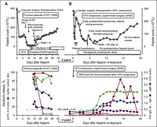 Figure 1. UFH reexposure for urgent cardiac surgery in a patient with a history of HIT. Patient 8 in Table 1. (A) Summary of the clinical (upper panel) and serological (lower panel) features of the patient’s previous episode of HIT (1999). The patient had unusually severe HIT but ultimately did well with therapeutic-dose danaparoid sodium (no new or progressive thrombosis and no ischemic limb loss). The patient tested strongly positive in the SRA, EIA-IgG, and EIA-IgA, and weakly positive in the EIA-IgM tests. (B) Summary of the clinical (upper panel) and serological (lower panel) features of the patient’s UFH reexposure to permit urgent cardiac surgery (2002). After reexposure to UFH, the patient had early-onset and persistent thrombocytopenia (platelet count nadir, 29 × 109/L on POD 6), but this was not related to HIT (the SRA tested negative on POD6). The prolonged period of postoperative thrombocytopenia was probably also unrelated to subsequent formation of platelet-activating antibodies, given that the platelet count recovery occurred as the patient was developing a strongly positive SRA, and given that the buffer control (ie, at 0 U/mL UFH) reactivity in the SRA remained negative throughout the postoperative period and also remained negative in the presence of danaparoid (data indicating absence of danaparoid cross-reactivity not shown). IV, intravenous.