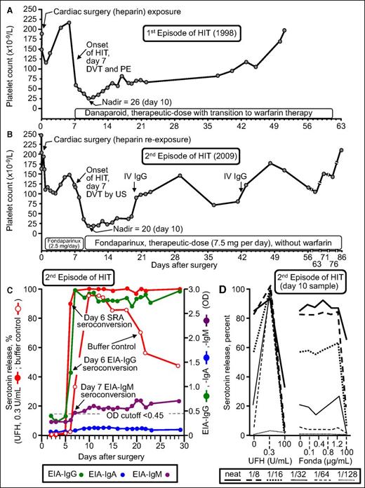 Figure 4. Patient with recurrent HIT after UFH reexposure for elective heart surgery. Patient 17 in Table 1. (A) First episode of HIT (1998) complicated by symptomatic deep vein thrombosis (DVT) and pulmonary embolism (PE). (B) Second episode of HIT after intraoperative UFH rechallenge (2009). The patient developed HIT on POD7, with associated asymptomatic DVT shown by venous ultrasound (US). (C) Timing of SRA and EIA seroconversion after UFH reexposure. Both the EIA-IgG and SRA became positive on POD6. IgM seroconversion occurred on POD7. Serotonin release at buffer control (ie, at 0 U/mL UFH) was very strong (>90% from POD10 to POD13), which explains why the patient developed HIT despite not receiving postoperative heparin. (D) Assessment of UFH- and fondaparinux-dependent platelet activation in the presence of patient serum at various dilutions. Strong serum-induced platelet activation (>80% serotonin release) was observed at 0 U/mL UFH (ie, buffer control), using neat and 1/8 diluted serum; strong heparin-dependent platelet activation was shown by the increase in serotonin release at 0.3 U/mL UFH compared with buffer control at higher dilutions of serum (1/16, 1/32, 1/64, 1/128). The absence of fondaparinux-dependent platelet activation argues against fondaparinux cross-reactivity as an explanation for the patient’s persisting thrombocytopenia. Fonda, fondaparinux. Reprinted from Warkentin et al18 with permission.
