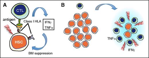 Figure 1. Immune-mediated mechanism of AA and clonal evolution. (A) AA is thought to be initiated by recognition and destruction of HSCs by CTLs, which recognize some unknown antigen present on HSCs via their HLA class I molecule. Supporting this hypothesis is a limited usage of T-cell receptor Vβ subsets at diagnosis, suggestive of the presence of oligoclonal expansion of CD8+CD28− T cells, which diminish or disappear with successful IST.1-3 Overproduction of inflammatory cytokines, including interferon γ (IFNγ) and tumor necrosis factor α (TNFα), from aberrantly activated immune cells and stromal microenvironments is also suggested to make a significant contribution to BM failure, in which the role of FAS-mediated apoptosis has been implicated.4 (B) During and/or after immune-mediated BM destruction, a rapid expansion of residual cells (which escaped destruction) occurs, whereby cells carrying mutations achieve clonal dominance and may progress to malignant proliferation. CTL, cytotoxic T cell; HSC, hematopoietic stem cell; IST, immunosuppressive therapy.