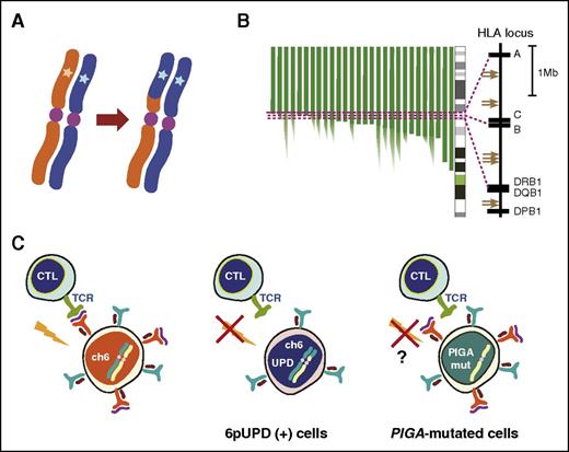 Figure 5. Putative mechanism of immune escape of 6pUPD-positive clones. (A) A schematic diagram of 6pUPD, which is thought to result from a recombination between 2 homologous chromosomes, invariably involving 6pter distally. (B) Breakpoint mapping of 6pUPD in different patients, showing a prominent breakpoint cluster within the HLA class I region. Breakpoints in critical cases are shown by arrows. (C) 6pUPD-positive (+) HSCs permanently lose the relevant HLA class I molecule required for the presentation of the putative antigen and are thereby thought to escape destruction by CTLs. The 6pUPD-mediated mechanism for immune escape in AA is also supported by the presence of multiple independent 6pUPD clones affecting the same parental HLA allele in some patients.63