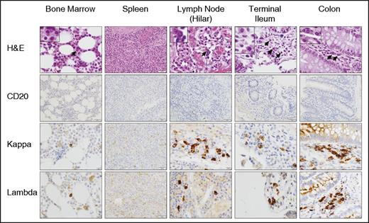 Figure 4. CTL019 results in B-cell depletion in primary and secondary lymphoid tissues. Sections of bone marrow, spleen, lymph nodes, terminal ileum, and colon, obtained at autopsy from a CTL019-treated subject (day 234), were analyzed by H&E and IHC (CD20, κ, λ). Representative sections are shown at ×20 (all spleen and CD20 images) and ×40 magnification (all other images). H&E insets are shown at ×100 magnification.