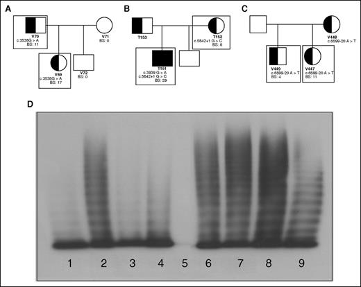 Figure 1. Family pedigrees; patient genotypic and phenotypic characteristics. Patients included in this study are outlined with boxes. (A) Family 1 with an exonic mutation, c.3538G>A, causing type 2A VWD in a father and daughter. (B) Family 2 with a consensus splice site mutation, c.5842+1G>C, causing mild type 1 VWD mother and type 3 VWD when coinherited with c.3939G>A in her son. (C) Family 3 with an intronic mutation c.5699-20A>T causing type 1 VWD in 2 siblings. (D) Plasma multimers from affected individuals. (1) Abnormal type 2A VWD control; (2) NPP control; (3) patient V69 with reduced HMWM; (4) patient V70 with reduced HMWM; (5) patient T151 showing no multimers; (6) patient T152 with full-range multimers; (7) patient V447 with full-range multimers; (8) patient V449 with full-range multimers.