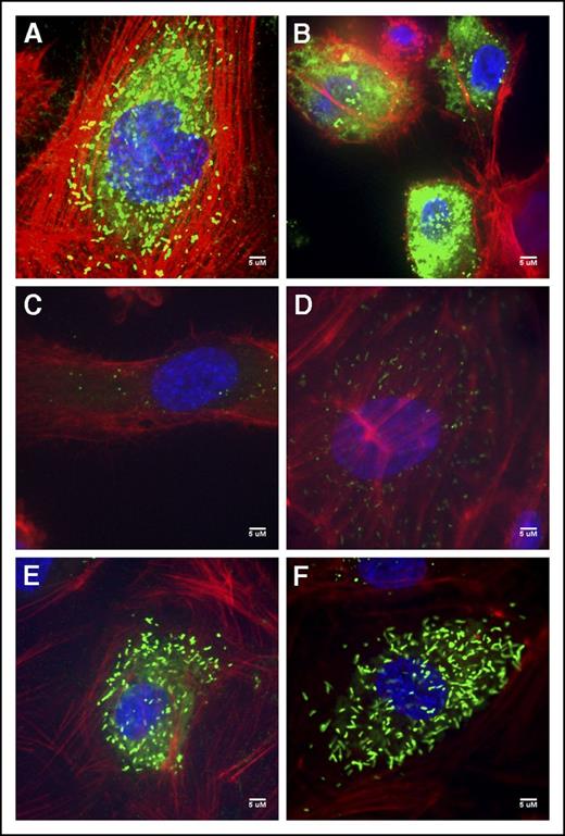 Figure 3. Normal and patient BOEC VWF immunofluorescent confocal images. (A) Normal BOECs with rod-shaped WPBs. (B) Patient V70 (c.3538G>A) with punctate VWF as well as diffuse VWF staining throughout the cells. (C) Type 3 patient T151 (c.3939G>A, c.5842+1G>C) with few punctate WPBs. (D) Patient T152 (c.5842+1G>C) BOECs show not only more classic, but also rounded WPBs. (E) Patient V447’s (c.6599-20A>T) VWF appears diffuse within the cell as well as localized to punctate WPBs. (F) VWF staining in patient V449’s (c.6599-20A>T) appear relatively normal with many rod-shaped WPBs.). Imaging was conducted at room temperature using a Quorum Wave Effects Spinning Disc confocal microscope at ×60 magnification and captured with a Hamamatsu Orca high-resolution camera and ImageJ software analysis. Scale bar, 5 μM.