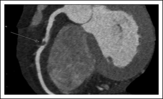 Figure 1. Coronary computerized tomography demonstrating atherosclerotic occlusion of the right coronary artery.
