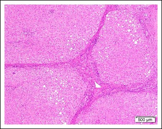Figure 2. Photomicrograph of a cirrhotic liver illustrating well developed fibrous septa separating irregular regenerative nodules. The hepatocytes show mild steatosis (hematoxylin and eosin stain, original magnification ×40).