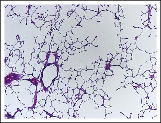 Figure 3. This lung shows centrilobular emphysema with dropout of alveolar walls surrounding the bronchiole (hematoxylin and eosin stain, original magnification ×4).