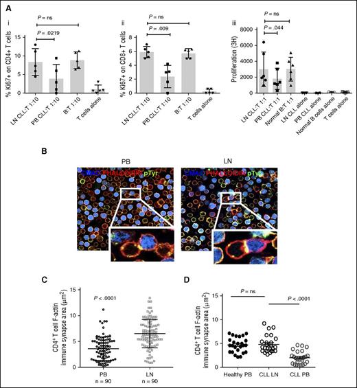 Figure 2. LN-CLL cells are functionally better at T-cell activation and induce superior CLL:T-cell synapses. (A) Paired LN and PB-CLL cells (irradiated for thymidine-incorporation assays) from 6 patients and B cells from 5 normal donors were mixed at a 1:1 or 1:10 ratio with allogeneic T cells in triplicate. Compared with PB-CLL cells, LN-CLL cells and normal B cells have an increased ability to stimulate T-cell activation and proliferation, as shown by increased expression of Ki67 on gated CD4+ (Ai) cells and CD8+ cells (Aii) after a 48-hour coculture, and increased thymidine-incorporation by CD3+ T cells in a 5-day MLR (Aiii). (B) To investigate the ability of the LN-derived CLL cells to induce autologous T-cell synapse formation compared with PB-CLL cells and normal B cells, we measured the area of filamentous actin polymerization in 90 CLL or B-cell:CD4+ T-cell conjugates in 4 paired patient samples and 1 paired normal sample. This representative figure from 1 patient shows the increased synapse formation induced by the LN-derived CLL cells compared with matched PB-CLL cells. (C) Representative result from 1 patient showing that synapse area was significantly greater when LN-derived CLL cells were used (mean synapse area induced by LN-CLL 6.534 μm2 ± 2.7 vs PB-CLL 3.594 μm2 ± 2.3; P < .0001). (D) Representative result from another patient demonstrating the synapse area generated by LN-CLL cells is comparable to that of normal B cells. ns, not significant; pTyr, phosphotyrosine.