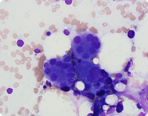 A 19-year-old previously healthy woman presented with cytopenias. Her complete blood cell count demonstrated: white blood cell count, 3.6 × 109/L (normal, 4.5-13.0); hemoglobin, 112 g/L (normal, 115-153), and platelet count, 124 × 109/L (normal, 140-400). An absolute monocyte count of 0.18 × 109/L (normal, 0.20-0.90) was noted. Her absolute neutrophil count was 1.98 × 109/L (normal, 1.8-8.0). Her absolute B-cell count was 0.064 × 109/L (normal, 0.13-0.80) and there was no natural killer lymphopenia. CD4 lymphopenia was absent; however, the CD4:CD8 ratio was 0.97 (normal, 1.00-2.90). Family history was significant for a sister with cytopenias and marrow hypocellularity. Her father had cytopenias and human papillomavirus (HPV)–associated anorectal cancer. The peripheral smear was unremarkable. Bone marrow examination showed a hypocellular bone marrow (cellularity 20%). Megakaryocytic atypia was noted as depicted: large osteoclast-like megakaryocytes with multiple separated nuclear lobes (original magnification ×100). No fibrosis was noted. Cytogenetic evaluation demonstrated a normal karyotype. A mutation affecting a single allele in GATA2 was documented (p.R361P). / The low levels of blood cells, especially B cells, and monocytes with marrow hypocellularity and dysplasia in the context of family members with similar findings and HPV-associated anorectal cancer were suggestive of GATA2 deficiency–associated bone marrow disorder, which has a high risk of progressing to overt myelodysplastic syndrome/acute myeloid leukemia.