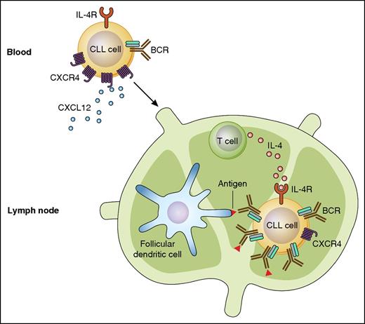 Regulation of BCR expression on CLL cells by IL-4. CLL cells in peripheral blood have downmodulated BCRs, presumably to prevent inappropriate activation by antigen in the absence of co-stimulatory signals. In response to CXCL12 and other chemokines, these cells migrate to the lymph nodes, where locally secreted IL-4 induces CD79b and increases translocation of the BCR complex to the leukemic cell surface. This mechanism increases the likelihood that CLL cells encounter and interact with antigen in the appropriate context. IL-4R, IL-4 receptor. Professional illustration by Patrick Lane, ScEYEnce Studios.