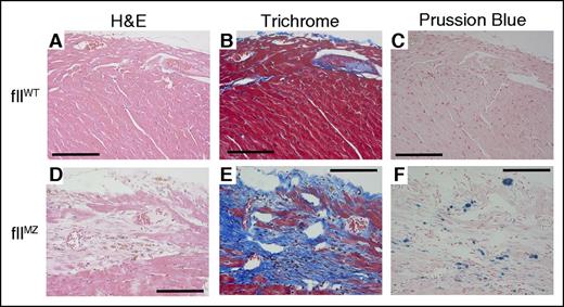 Figure 6. Cardiac fibrosis in fIIMZ mice. FIIWT mice did not have any evidence of cardiac fibrosis or hemorrhage/iron deposition (A-C). However, fIIMZ animals developed evidence of cardiac fibrosis by the age of 10 weeks on both hematoxylin and eosin and Trichrome stains (D-E). At 10 weeks of age in mice, the most pronounced area of fibrosis was in the subepicardial region. Areas of fibrosis colocalize with areas of iron deposition, as shown here in Prussian blue stain (F). All scale bars represent 100 microns.