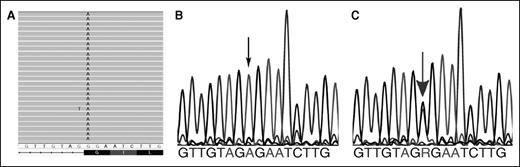 Figure 1. Mutation identification. (A) Exome sequencing. Graphical representation of sequence tags from exome sequencing (HX proband, exon 13). All 26 full-length reads have an A instead of a G, leading to a missense mutation, Gly to Arg at amino acid 614, which also disrupts the normal splicing at the 3′ acceptor splice site of the exon, ag:G to ag:A. (B) Sanger sequencing confirmation of HK1 gene mutations (proband). The corresponding partial exon 13 sequence from the proband reveals only homozygous “A” at the beginning of the exon, denoted by the small black arrow. (C) Sanger sequencing confirmation of HK1 gene mutations (parents). The corresponding partial exon 13 sequence from the mother reveals both “A” and “G” alleles, denoted by the large gray arrow, indicating the presence of wild-type and mutant alleles. Similar findings were observed in the father (not shown).