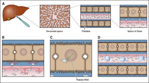 Figure 1. Potential mechanisms underlying platelet-mediated liver regeneration. (A) Platelets accumulate in the sinusoidal space of injured livers or livers that have been surgically reduced in size. From the sinusoidal space, some platelets migrate into the Space of Disse and some platelets are taken up by hepatocytes. These platelets have the potential to activate multiple pathways that may all contribute to platelet-mediated stimulation of liver regeneration. Which of these pathways occur in vivo has not been definitively established. (B) Platelets may release contents from their granules that either directly stimulate hepatocyte proliferation (serotonin, IGF, and HGF) or stimulate endothelial cells to release HGF (VEGF). Alternatively, the direct interaction of platelets with endothelial cells promotes release of interleukin 6 and VEGF that promote liver regeneration. (C) Platelets may transfer their RNA to hepatocytes, which promotes hepatocyte proliferation either by translation of mRNA or by the action of regulatory RNAs. (D) Platelets attract inflammatory cells, which are known to directly stimulate liver regeneration. Professional illustration by Patrick Lane, ScEYEnce Studios.